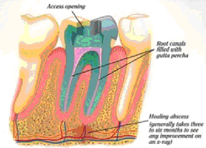 East Cobb Endodontic -What Is Endodontics?